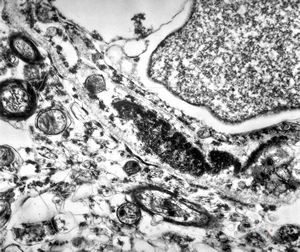 M,71y. | Alzheimer diseaseaccompanied with CADASIL